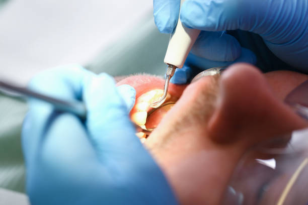 Best Chipped Tooth Repair Near Me  in Monticello, KY